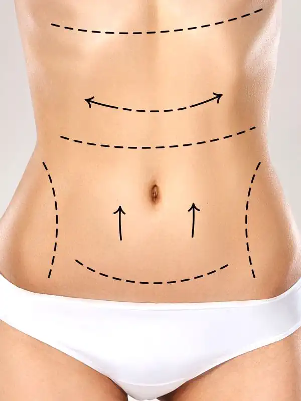 Abdominoplasty